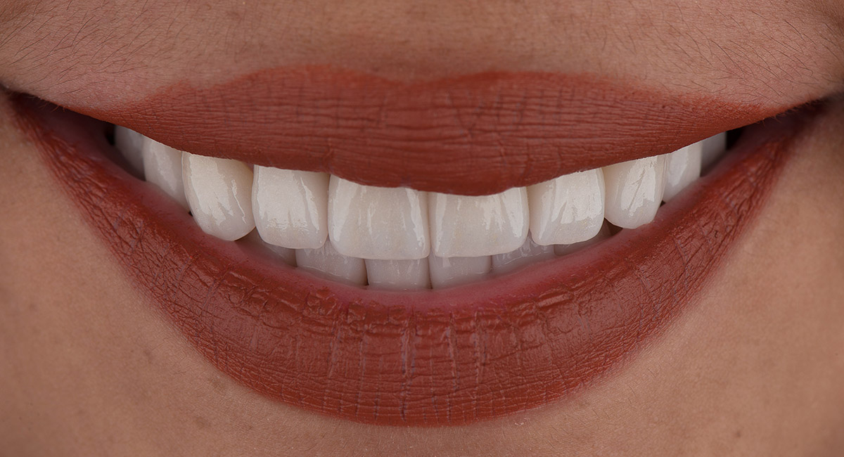 Porcelain Veneers in Farmington Utah MVP Dental