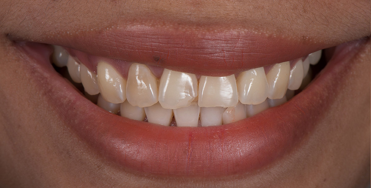 Porcelain Veneers in Farmington Utah MVP Dental